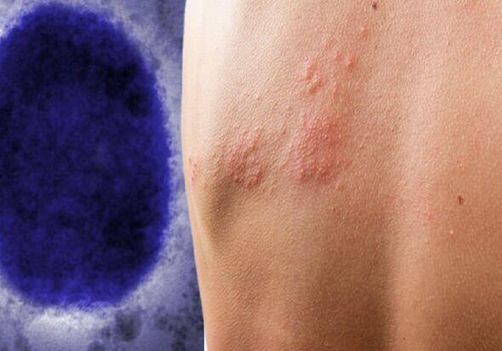 Ευλογιά των πιθήκων: Επιβεβαιώθηκε τρίτο κρούσμα στην Ελλάδα