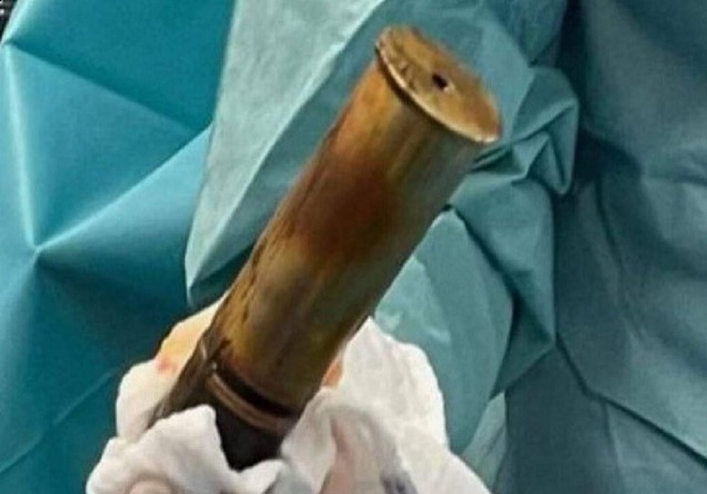 Εκκενώθηκε νοσοκομείο μετά την άφιξη 88χρονου με οβίδα στον πρωκτό του!