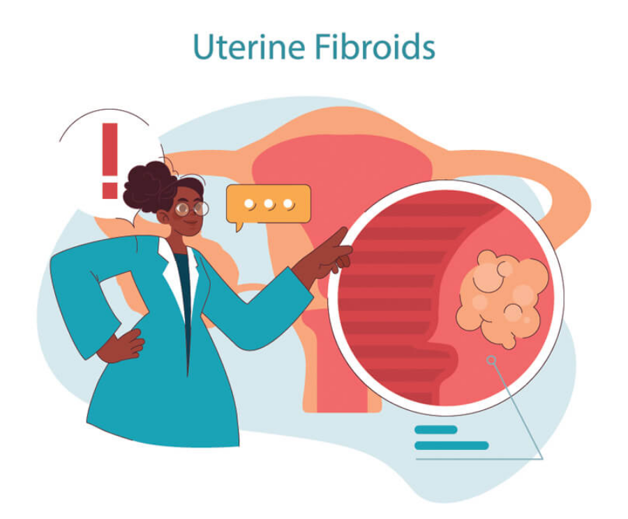 Ινομυώματα: Συμπτώματα, διάγνωση και αντιμετώπιση με εμβολισμό