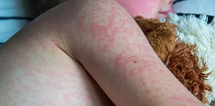 Η ιλαρά παραμένει ενεργή στην Ευρώπη – Οδηγίες εμβολιασμού από ΕΟΔΥ και ECDC