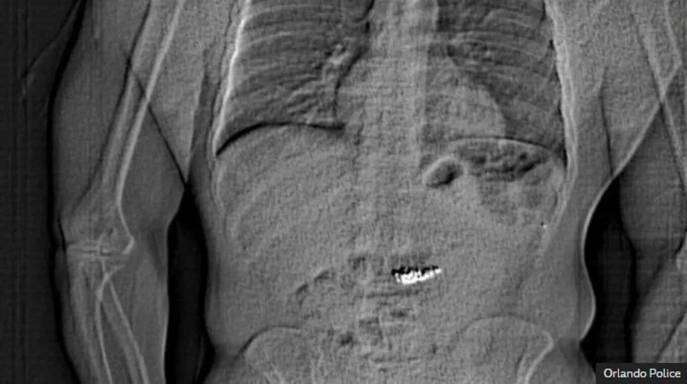 Απίστευτο: 32χρονος ζούσε επί 20 χρόνια με θερμόμετρο υδραργύρου στο στομάχι