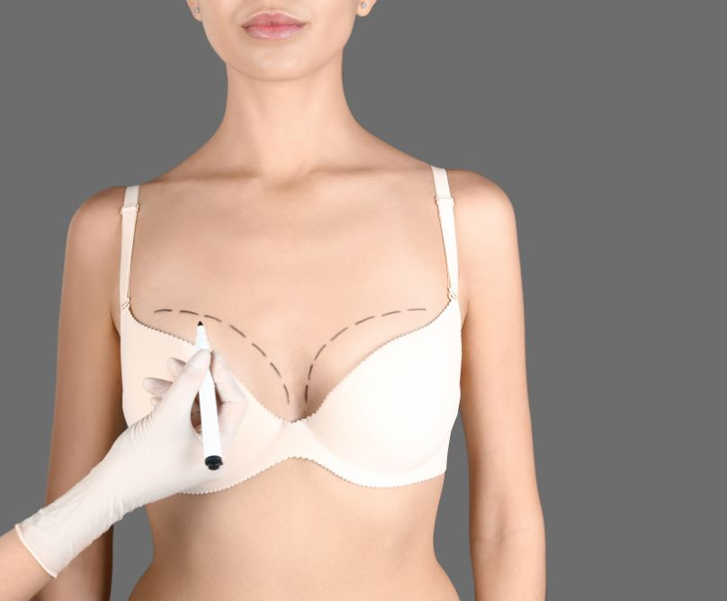 Αυξητική μαστών και ανόρθωση στο ίδιο χειρουργείο για φυσικό αποτέλεσμα