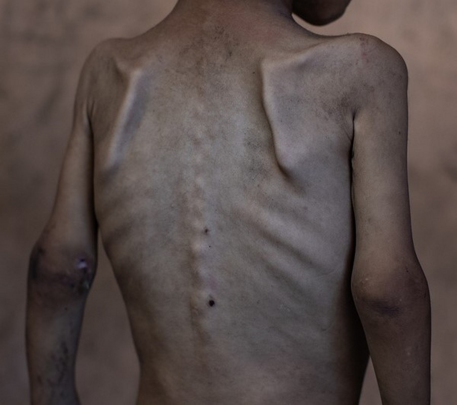 ΟΗΕ για το λιμό στη Γάζα: «Είναι απολύτως ανθρωπογενής»