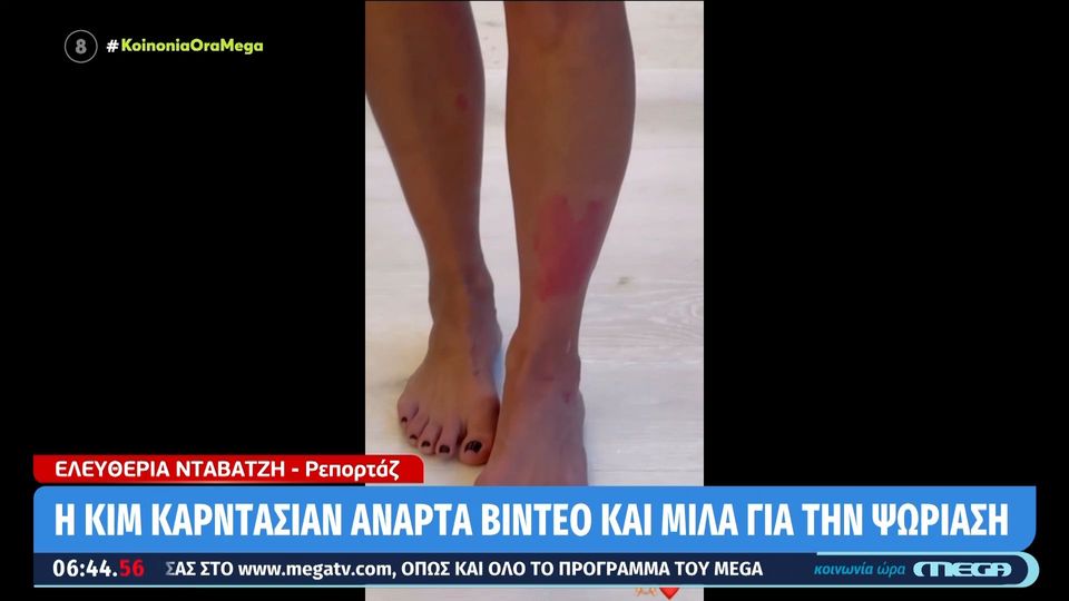 Παγκόσμια Ημέρα Ψωρίασης: Οι διάσημοι που «ανοίχτηκαν» για την ψωρίαση (VIDEO)